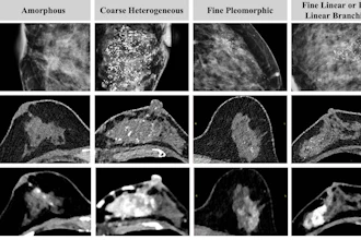 Detection and extent of BI-RADS suspicious calcifications (amorphous, coarse heterogeneous, fine pleomorphic, and fine linear or fine linear branching) at axial photon-counting CT (PCCT) versus full-field digital mammography (first three images, craniocaudal view; last image, mediolateral oblique view). Calcifications found on mammography showed only partial visualization at ultrahigh-resolution PCCT (0.2 mm), while amorphous calcifications could not be distinguished from image noise. Corresponding abnormal enhancement was clearly depicted on contrast-enhanced PCCT images.