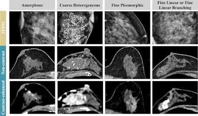 Detection and extent of BI-RADS suspicious calcifications (amorphous, coarse heterogeneous, fine pleomorphic, and fine linear or fine linear branching) at axial photon-counting CT (PCCT) versus full-field digital mammography (first three images, craniocaudal view; last image, mediolateral oblique view). Calcifications found on mammography showed only partial visualization at ultrahigh-resolution PCCT (0.2 mm), while amorphous calcifications could not be distinguished from image noise. Corresponding abnormal enhancement was clearly depicted on contrast-enhanced PCCT images.