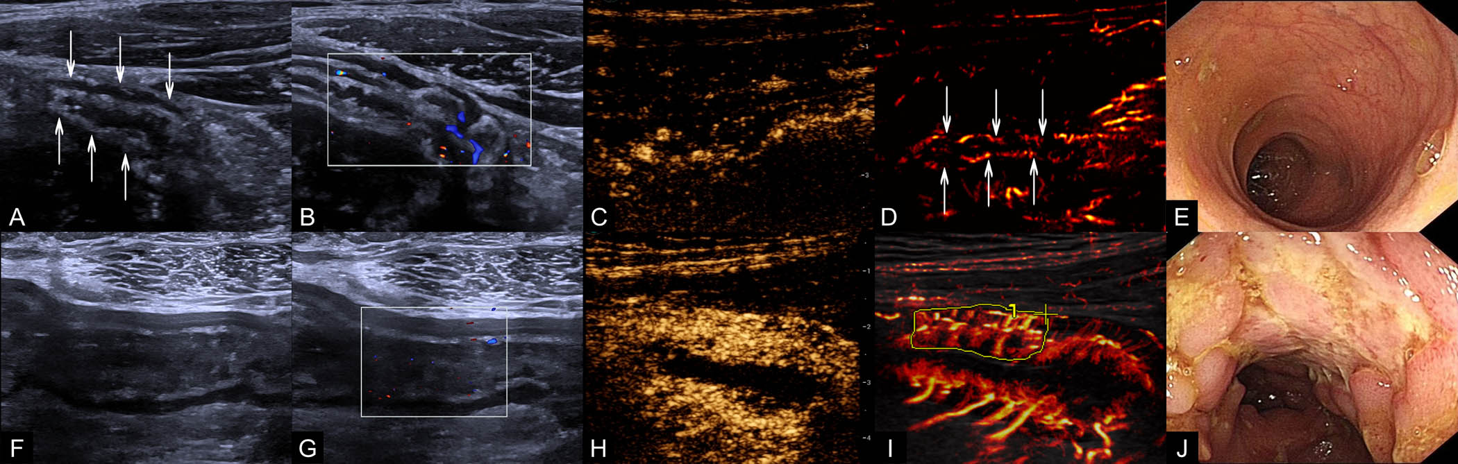 Representative multimodal ultrasound and endoscopic images in participants with Crohn's disease. Top row depicts findings in a 26-year-old male participant with Crohn's disease in remission. Bottom row illustrates findings in a 25-year-old male participant with severe active Crohn's disease. The terminal ileum was the most prominently thickened bowel segment in both participants. Paired images comparing imaging modalities are shown. (A, F) Grayscale US images of the longitudinal section; arrows in A indicate the intestinal wall. (B, G) Color Doppler flow images of the longitudinal section; the box outlines the region of interest. In these two images, blue represents venous flow, while red represents arterial flow. (C, H) Conventional CEUS images of the longitudinal section. (D, I) Vascular density maps derived from super-resolution CEUS of the longitudinal section; arrows in D indicate the intestinal wall, and the outline in I indicates the measurement area for quantitative analysis. (E, J) Corresponding endoscopic images in the participants.