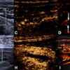 Representative multimodal ultrasound and endoscopic images in participants with Crohn's disease. Top row depicts findings in a 26-year-old male participant with Crohn's disease in remission. Bottom row illustrates findings in a 25-year-old male participant with severe active Crohn's disease. The terminal ileum was the most prominently thickened bowel segment in both participants. Paired images comparing imaging modalities are shown. (A, F) Grayscale US images of the longitudinal section; arrows in A indicate the intestinal wall. (B, G) Color Doppler flow images of the longitudinal section; the box outlines the region of interest. In these two images, blue represents venous flow, while red represents arterial flow. (C, H) Conventional CEUS images of the longitudinal section. (D, I) Vascular density maps derived from super-resolution CEUS of the longitudinal section; arrows in D indicate the intestinal wall, and the outline in I indicates the measurement area for quantitative analysis. (E, J) Corresponding endoscopic images in the participants.