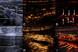 Representative multimodal ultrasound and endoscopic images in participants with Crohn's disease. Top row depicts findings in a 26-year-old male participant with Crohn's disease in remission. Bottom row illustrates findings in a 25-year-old male participant with severe active Crohn's disease. The terminal ileum was the most prominently thickened bowel segment in both participants. Paired images comparing imaging modalities are shown. (A, F) Grayscale US images of the longitudinal section; arrows in A indicate the intestinal wall. (B, G) Color Doppler flow images of the longitudinal section; the box outlines the region of interest. In these two images, blue represents venous flow, while red represents arterial flow. (C, H) Conventional CEUS images of the longitudinal section. (D, I) Vascular density maps derived from super-resolution CEUS of the longitudinal section; arrows in D indicate the intestinal wall, and the outline in I indicates the measurement area for quantitative analysis. (E, J) Corresponding endoscopic images in the participants.