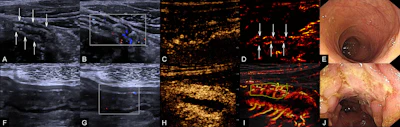 Super-resolution CEUS shows promise in Crohn's disease assessment