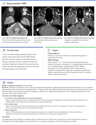 Representative report-to-output workflow for GPT-5-Thinking interpretation of orbital MRI scan. This figure shows how deidentified clinical context and MRI report findings from one pretreatment patient-level report input were converted into a structured GPT-5-Thinking diagnostic output. (A) Images in a 55-year-old woman with a left orbital mass detected during physical examination. Axial fat-suppressed T2-weighted MRI scan shows a well-circumscribed hyperintense lesion in the left intraconal space posterior to the globe (arrow). Axial early and delayed postcontrast T1-weighted MRI scans show early peripheral nodular enhancement with progressive centripetal fill-in. (B) Fixed prompt used for GPT-5-Thinking interpretation. (C) Deidentified clinical history and MRI report findings used as model inputs. (D) Structured model output, including benign–malignant classification, ranked differential diagnosis, rationale, and conclusion.