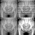 Example anteroposterior (AP) pelvic radiographs showing simulated acquisition artifacts used for stage 1 artifact-robust pretraining. Images are derived from the same AP pelvic radiograph from a 75-year-old woman with a CT- or MRI-confirmed left femoral-neck fracture. (A) Original AP pelvic radiograph. (B) Simulated grid or cable-shadow artifact. (C) Simulated motion-blur artifact. (D) Simulated sensor saturation or overexposure artifact.
