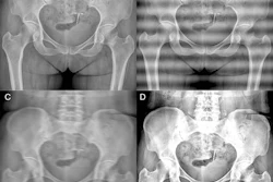 Example anteroposterior (AP) pelvic radiographs showing simulated acquisition artifacts used for stage 1 artifact-robust pretraining. Images are derived from the same AP pelvic radiograph from a 75-year-old woman with a CT- or MRI-confirmed left femoral-neck fracture. (A) Original AP pelvic radiograph. (B) Simulated grid or cable-shadow artifact. (C) Simulated motion-blur artifact. (D) Simulated sensor saturation or overexposure artifact.