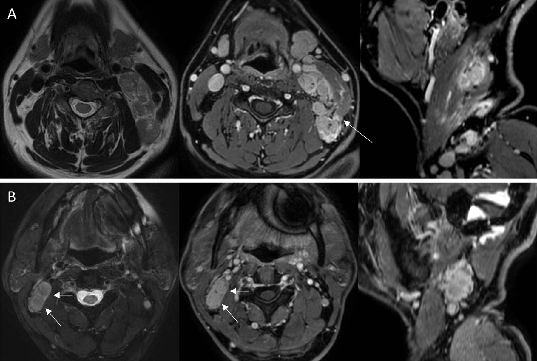Representative MRI scans for which the independently assigned imaging-derived extranodal extension (iENE) grades differed among the readers. (A) Axial and sagittal images in a 56-year-old male patient with nasopharyngeal carcinoma and cervical nodal metastases. Readers 1 and 3 interpreted the finding as a metastatic lymph node invading the left sternocleidomastoid muscle (arrow) and assessed an iENE grade of 3, whereas reader 2 assigned a grade of 2. After joint review, the radiologists reached a consensus on the absence of definite sternocleidomastoid muscle invasion, and the final iENE grade was 2. (B) Axial and sagittal images in a 52-year-old male patient with nasopharyngeal carcinoma and cervical nodal metastases. Reader 1 interpreted the findings as a single enlarged metastatic lymph node and assessed an iENE grade of 1, whereas readers 2 and 3 interpreted them as two coalescent metastatic lymph nodes (arrows) and assessed a grade of 2. After joint review, the radiologists reached a consensus on the coalescence of the two metastatic lymph nodes, and the final iENE grade was 2.