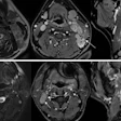 Representative MRI scans for which the independently assigned imaging-derived extranodal extension (iENE) grades differed among the readers. (A) Axial and sagittal images in a 56-year-old male patient with nasopharyngeal carcinoma and cervical nodal metastases. Readers 1 and 3 interpreted the finding as a metastatic lymph node invading the left sternocleidomastoid muscle (arrow) and assessed an iENE grade of 3, whereas reader 2 assigned a grade of 2. After joint review, the radiologists reached a consensus on the absence of definite sternocleidomastoid muscle invasion, and the final iENE grade was 2. (B) Axial and sagittal images in a 52-year-old male patient with nasopharyngeal carcinoma and cervical nodal metastases. Reader 1 interpreted the findings as a single enlarged metastatic lymph node and assessed an iENE grade of 1, whereas readers 2 and 3 interpreted them as two coalescent metastatic lymph nodes (arrows) and assessed a grade of 2. After joint review, the radiologists reached a consensus on the coalescence of the two metastatic lymph nodes, and the final iENE grade was 2.