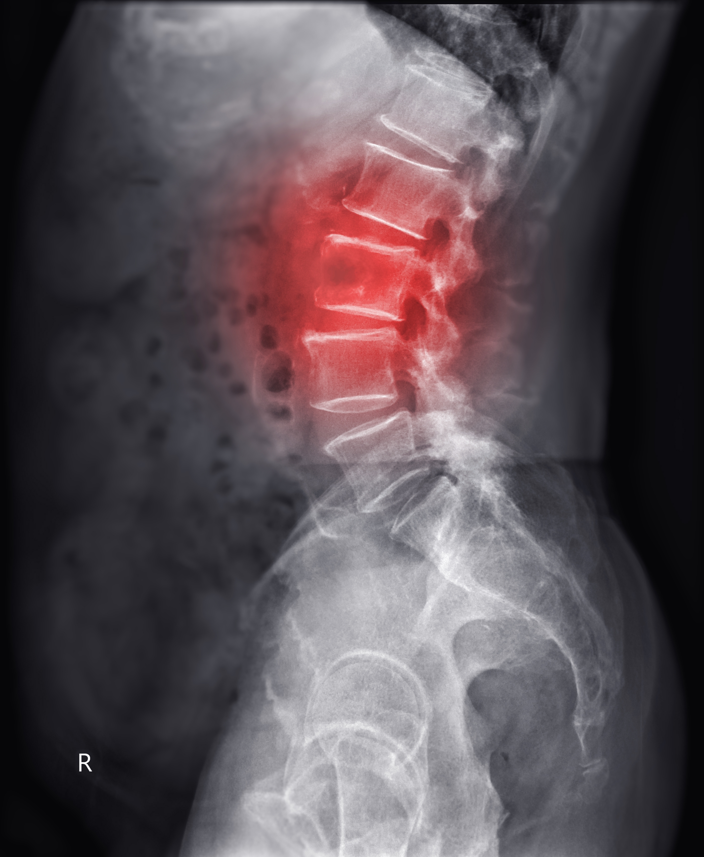 Lumbar Spine