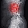 Lumbar Spine