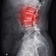 Lumbar Spine