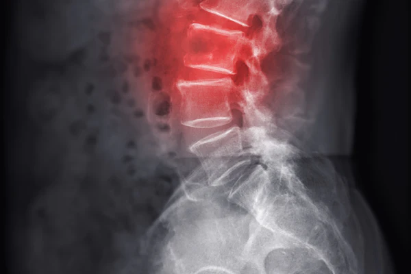 Lumbar Spine