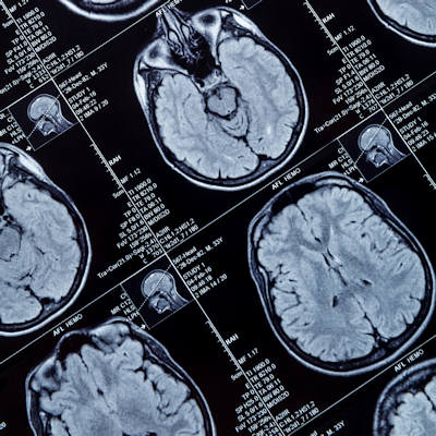 Mri Brain Head 400