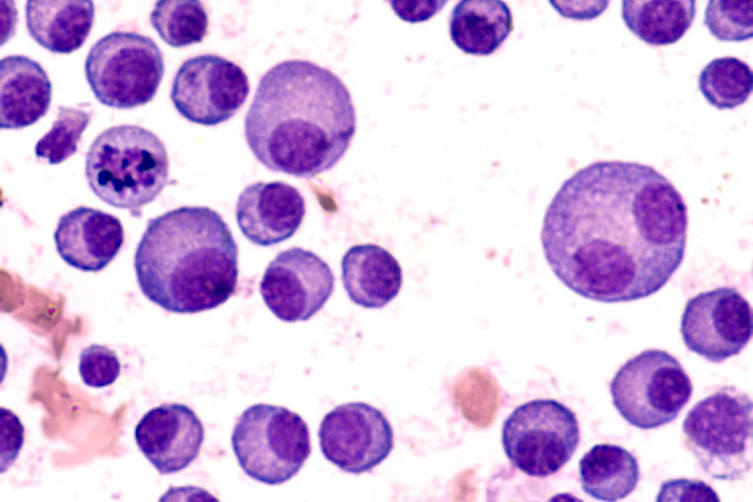 Multiple Myeloma 400