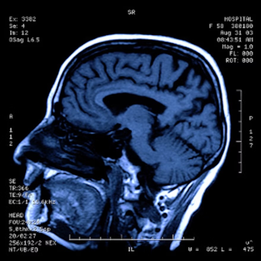 Structural Mri