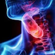 Throat Cancer