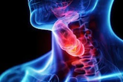 Throat Cancer