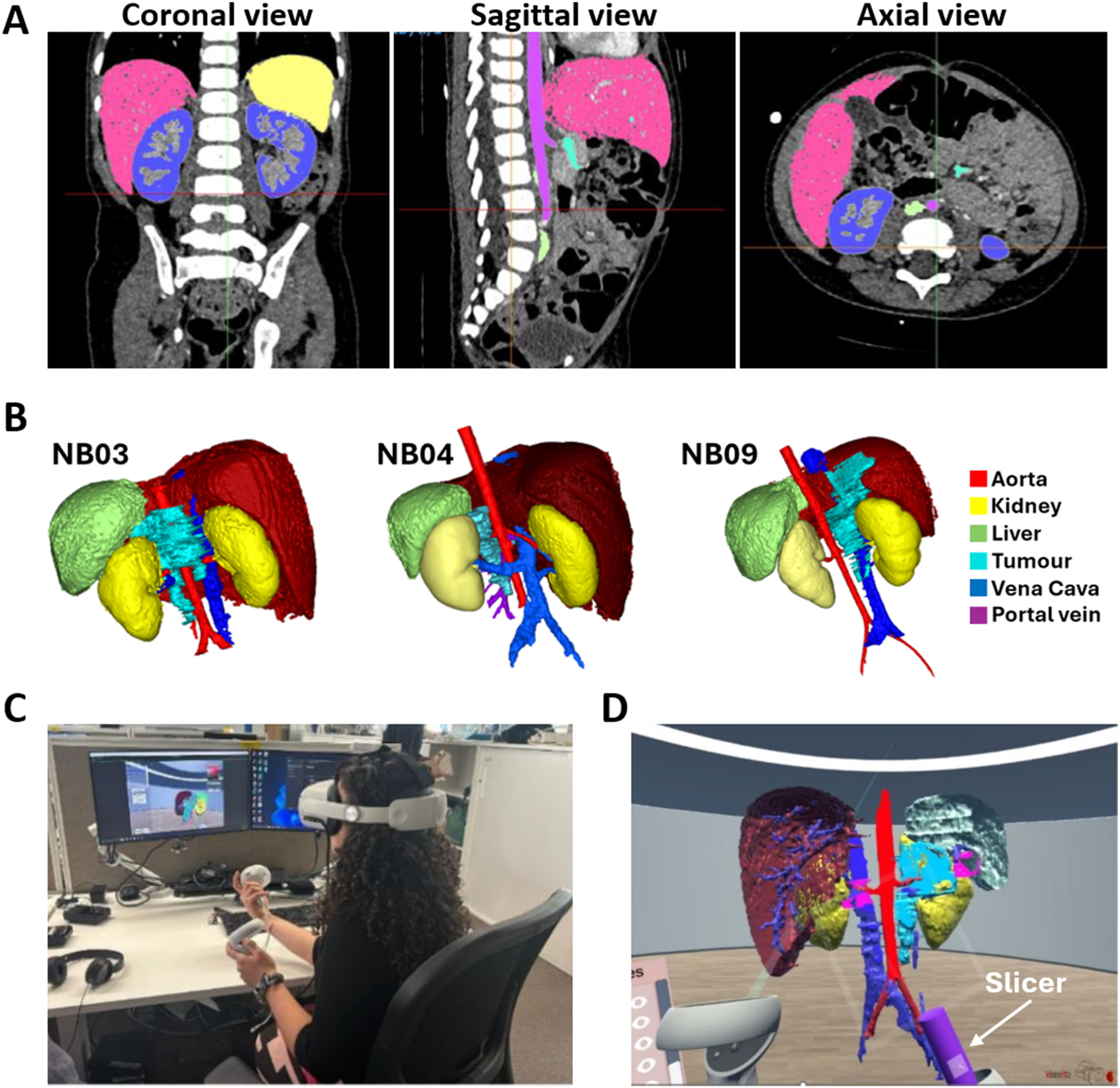 Medical CT scan visualization showing coronal, sagittal, and axial views with 3D organ segmentation including kidney, liver, aorta, and tumor models.