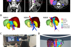 Medical CT scan visualization showing coronal, sagittal, and axial views with 3D organ segmentation including kidney, liver, aorta, and tumor models.