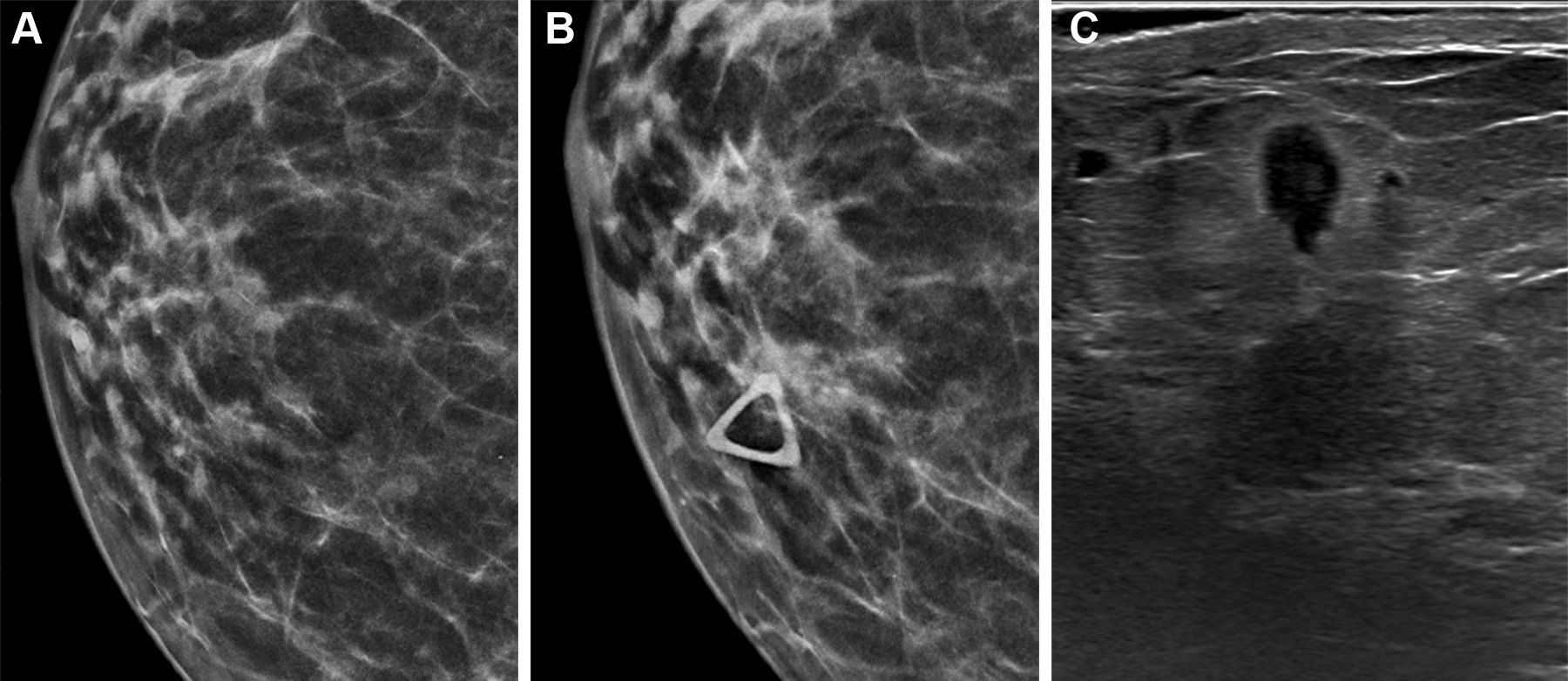 Breast imaging comparison showing mammogram views and ultrasound scan for diagnostic evaluation