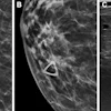 Breast imaging comparison showing mammogram views and ultrasound scan for diagnostic evaluation