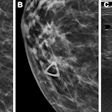 Breast imaging comparison showing mammogram views and ultrasound scan for diagnostic evaluation