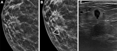Half of false-negative DBT exams are missed cancers