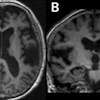 Brain MRI scans showing axial and coronal views of cerebral structures in grayscale