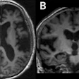 Brain MRI scans showing axial and coronal views of cerebral structures in grayscale