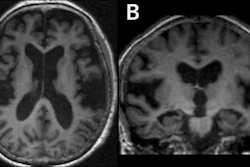 Brain MRI scans showing axial and coronal views of cerebral structures in grayscale
