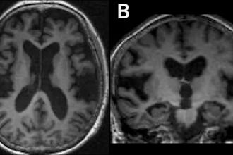 Brain MRI scans showing axial and coronal views of cerebral structures in grayscale