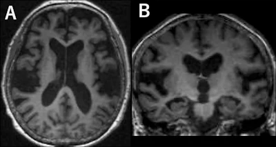 Brain MRI scans showing axial and coronal views of cerebral structures in grayscale
