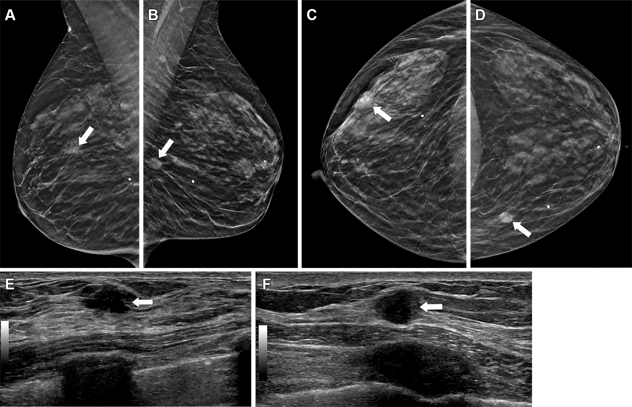 Mammography and ultrasound imaging showing breast tissue with clinical findings marked by arrows