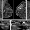 Mammography and ultrasound imaging showing breast tissue with clinical findings marked by arrows