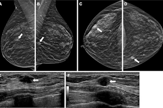 Mammography and ultrasound imaging showing breast tissue with clinical findings marked by arrows
