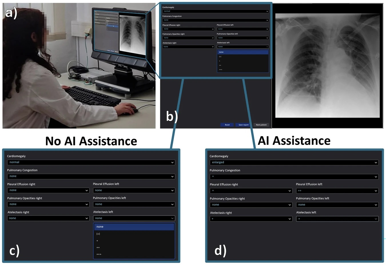 Radiologist comparing chest X-ray analysis with and without AI assistance using medical imaging software