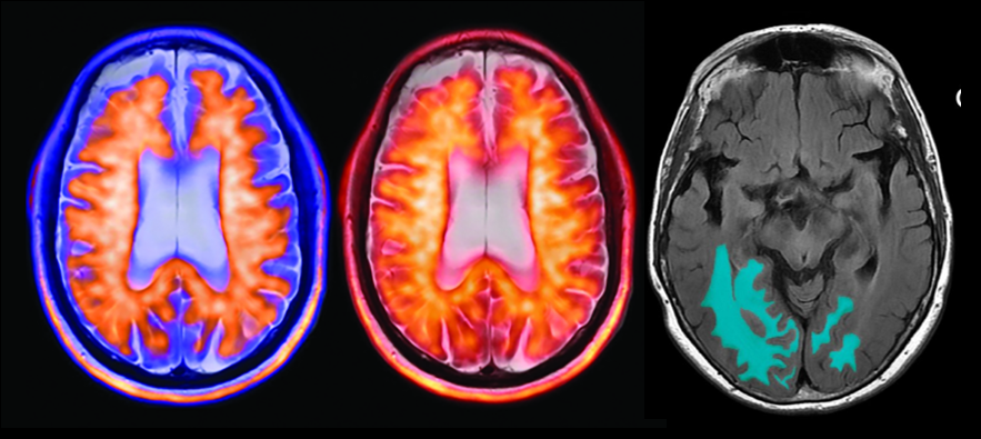 Axial brain imaging composite showing PET and MRI scans with metabolic activity and anatomical segmentation