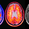 Axial brain imaging composite showing PET and MRI scans with metabolic activity and anatomical segmentation