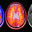 Axial brain imaging composite showing PET and MRI scans with metabolic activity and anatomical segmentation