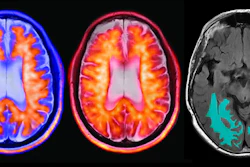 Axial brain imaging composite showing PET and MRI scans with metabolic activity and anatomical segmentation