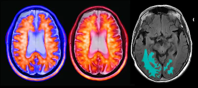 Axial brain imaging composite showing PET and MRI scans with metabolic activity and anatomical segmentation