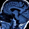 Sagittal MRI brain scan showing anatomical structures including ventricles and neural tissue