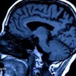 Sagittal MRI brain scan showing anatomical structures including ventricles and neural tissue