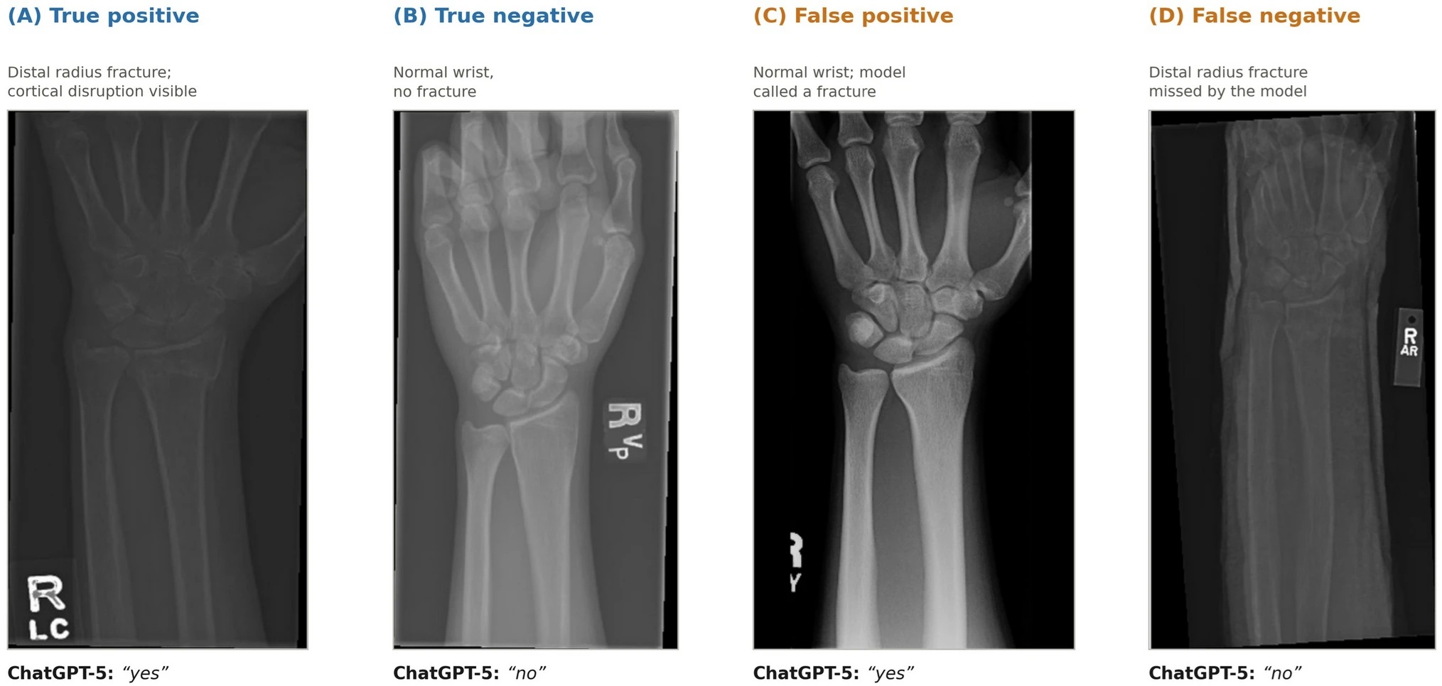 Four wrist X-ray images showing fracture detection examples: true positive with distal radius fracture, true negative normal wrist, false positive misidentified fracture, and false negative missed fracture.