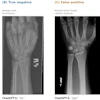 Four wrist X-ray images showing fracture detection examples: true positive with distal radius fracture, true negative normal wrist, false positive misidentified fracture, and false negative missed fracture.