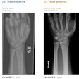 Four wrist X-ray images showing fracture detection examples: true positive with distal radius fracture, true negative normal wrist, false positive misidentified fracture, and false negative missed fracture.