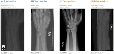 ChatGPT-5 misses half of distal radius fractures on x-rays