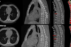 Baseline and 1-year follow-up CT and MRI scans of thoracic and lumbar spine with color-coded vertebral segmentation
