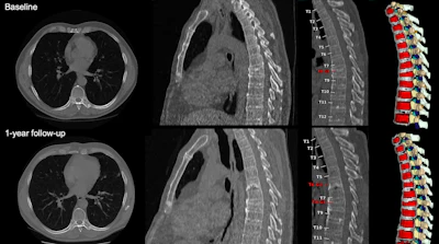 Baseline and 1-year follow-up CT and MRI scans of thoracic and lumbar spine with color-coded vertebral segmentation