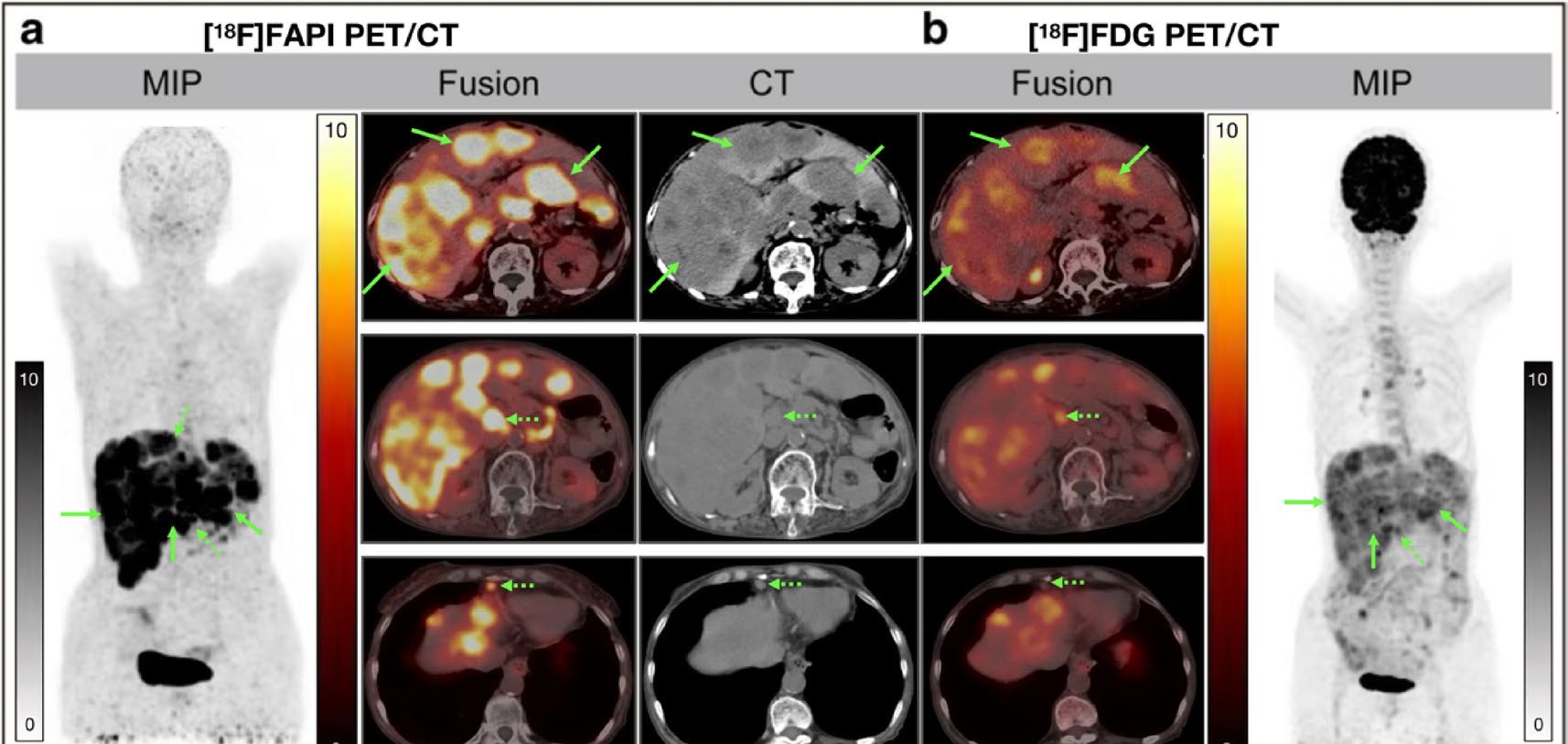 Comparative PET/CT scan images showing [18F]FAPI and [18F]FDG imaging with MIP projections, fusion views, and CT cross-sections for medical diagnosis