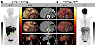 Comparative PET/CT scan images showing [18F]FAPI and [18F]FDG imaging with MIP projections, fusion views, and CT cross-sections for medical diagnosis